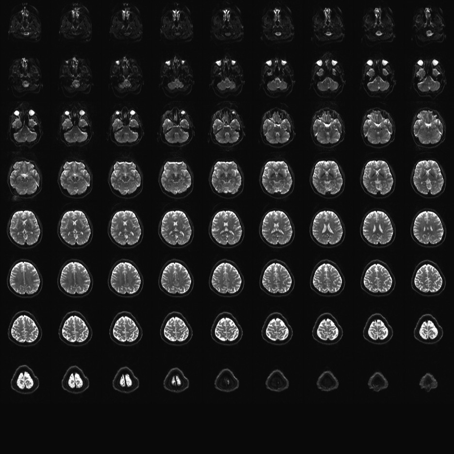 2mm diffusion MB2 IPAT.