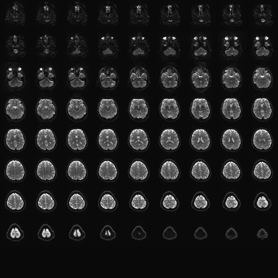 2mm diffusion MB3 IPAT.