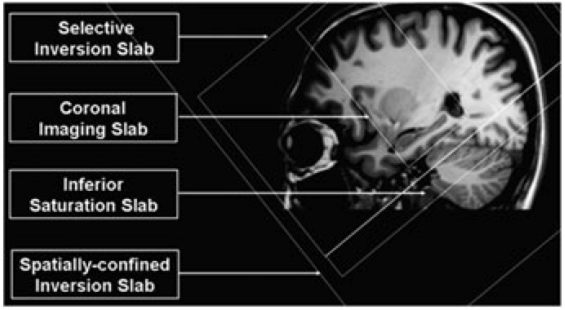 Sagittal view of a brain MRI showing 4 slab boxes